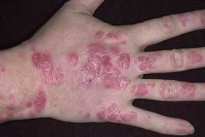 Que curar atopichesky la dermatitis al niño de 11 meses